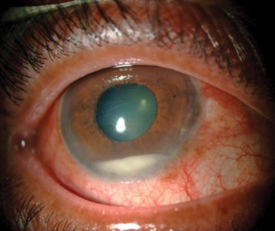 inflammation 6 weeks after cataract surgery