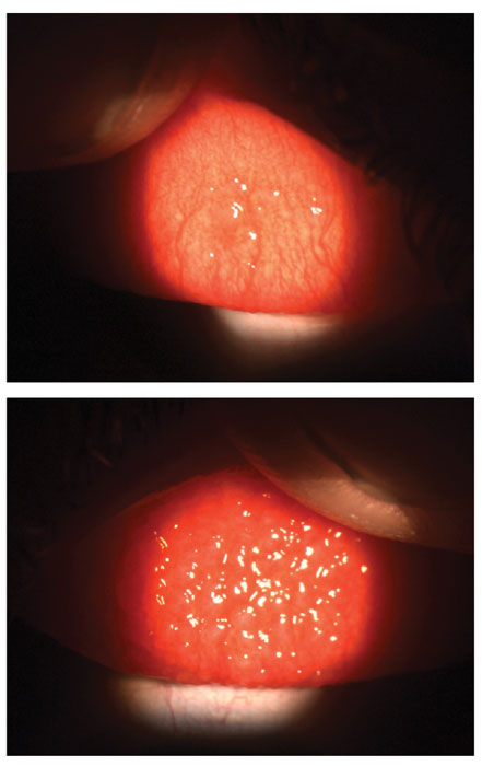 Patients with mild (above) or severe contact lens papillary conjunctivitis will have textured, inflamed eyelids, which can cause discomfort and keep them out of contact lens wear. 