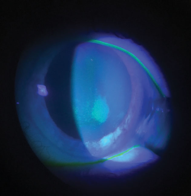 Fig. 1. Staining associated with preservative uptake and release. Corneal staining should be evaluated during a contact lens exam with consideration given to underlying mechanisms.