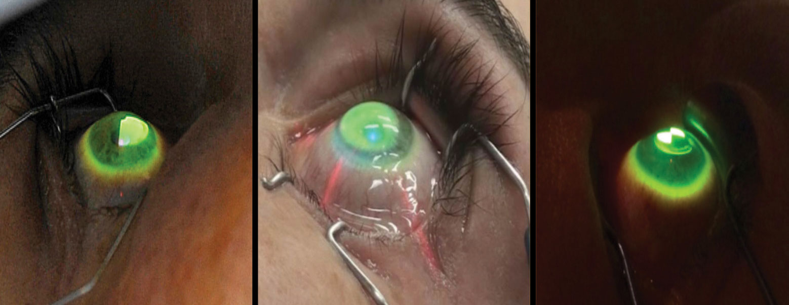 CXL can stop progression of keratoconus and can also help to preserve vision. Photo: International Keratoconus Academy