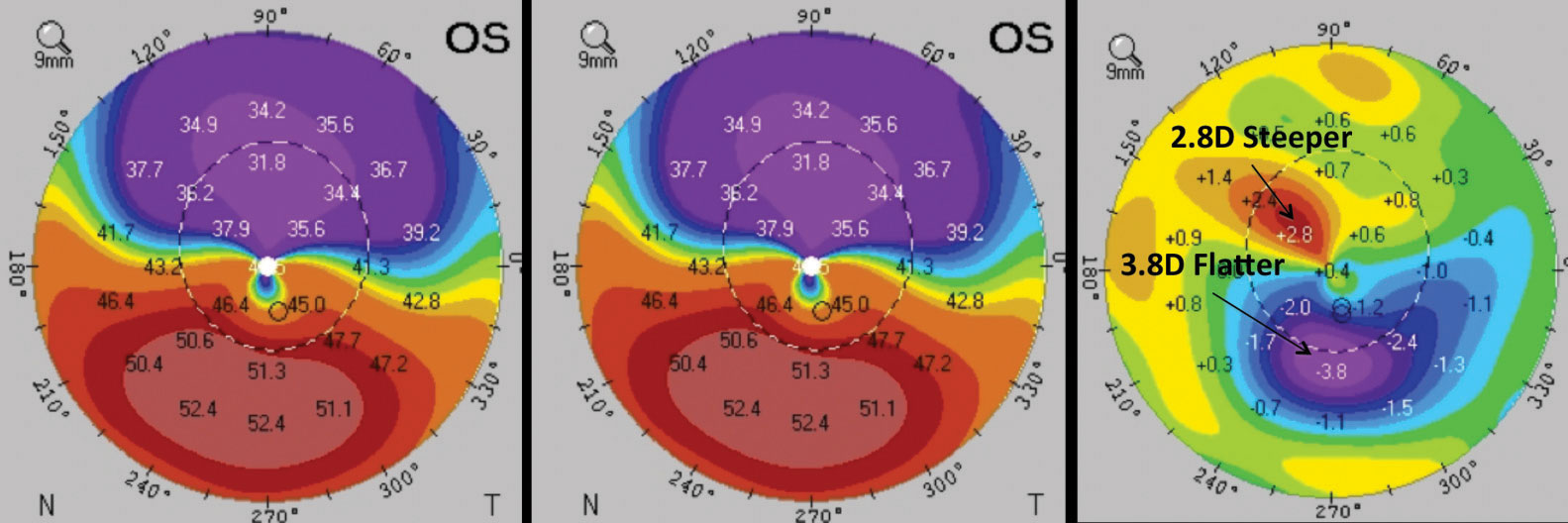 This patient underwent epi-on CXL. Comparing the pre-op (left) and post-op (middle) corneal thickness reveals significant changes in corneal parameters in the difference map (right). Images: William Trattler, MD; International Keratoconus Academy