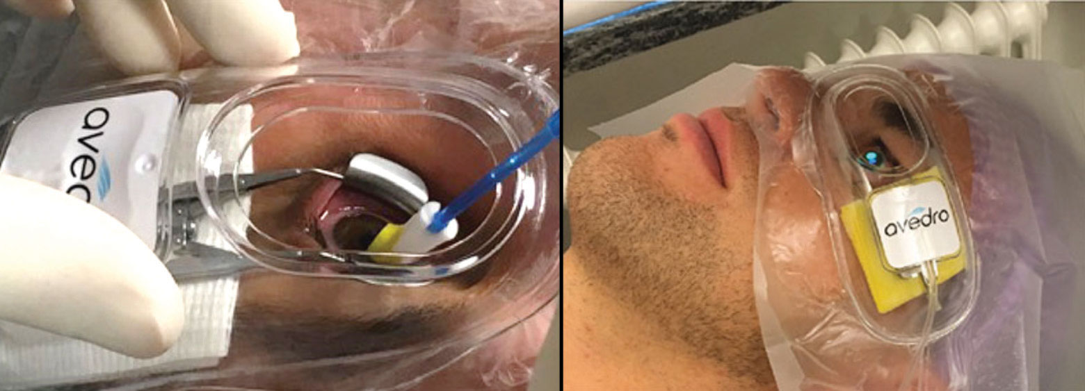 Epi-on/accelerated/oxygen-enhanced CXL remains investigational, but it might be common in the future. Photos: Avedro, International Keratoconus Academy