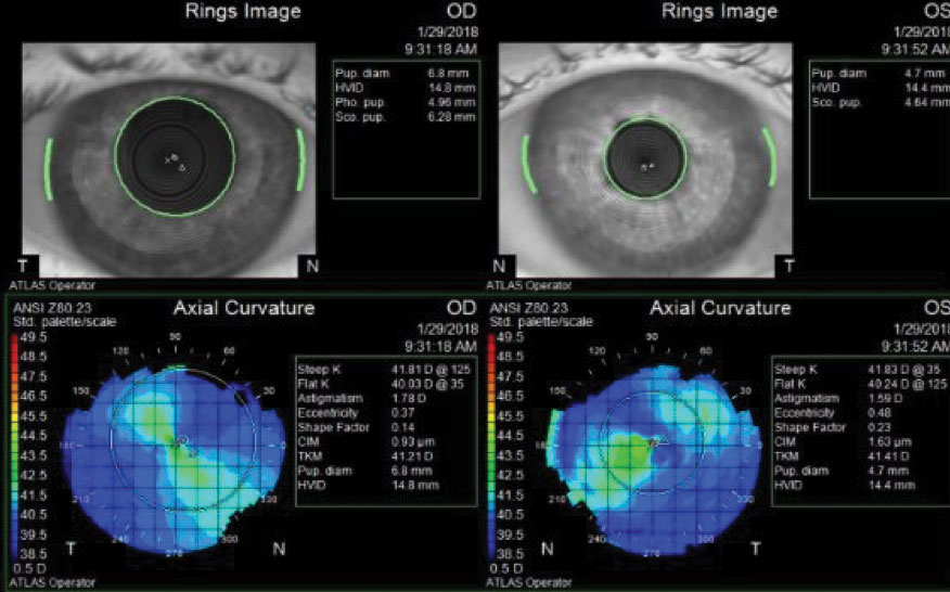 Fig. 1. Imaging reveals this patient’s HVIDs fall outside the normal range, at 14.4mm OD and 14.8mm OS, suggesting the need for custom contact lenses. 