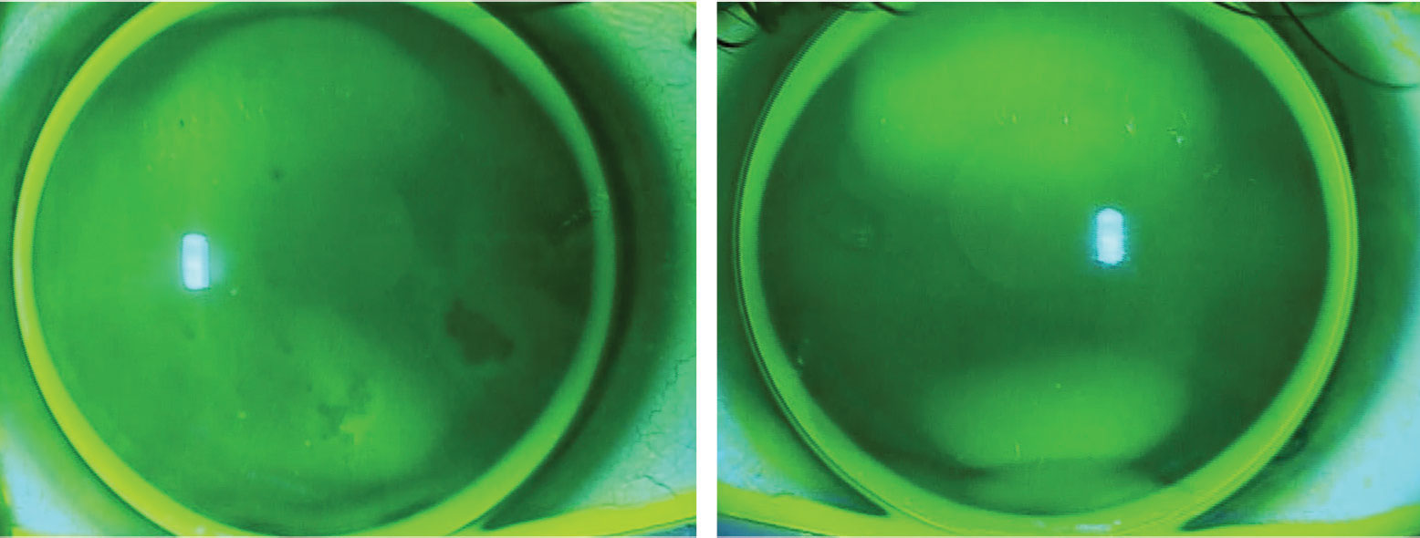 This patient has approximately 3.00D of corneal and refractive with-the-rule astigmatism and wears multifocal gas permeable lenses. 
