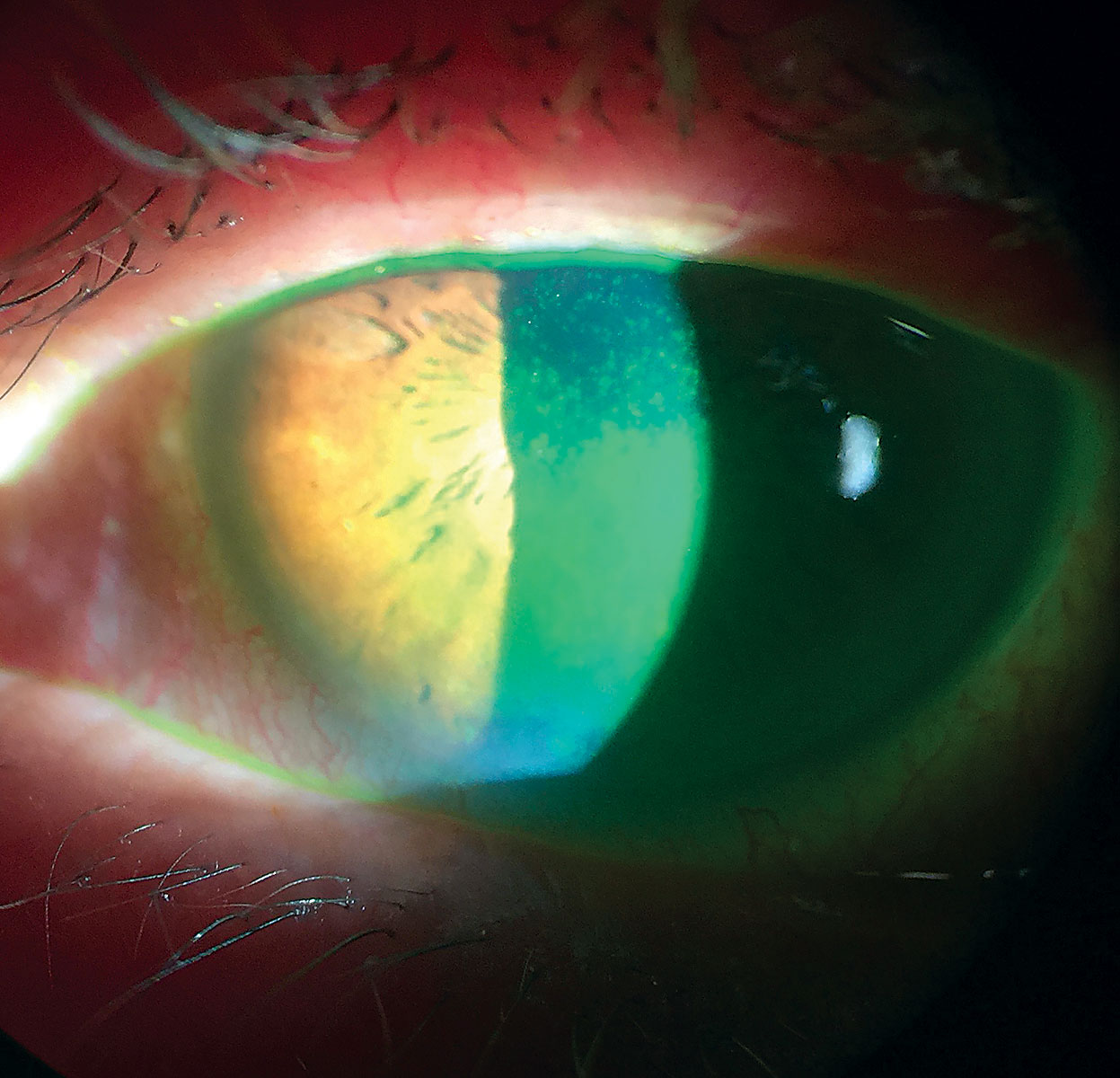 A cytokine coating for soft lenses could provide sustained dry eye treatment.
