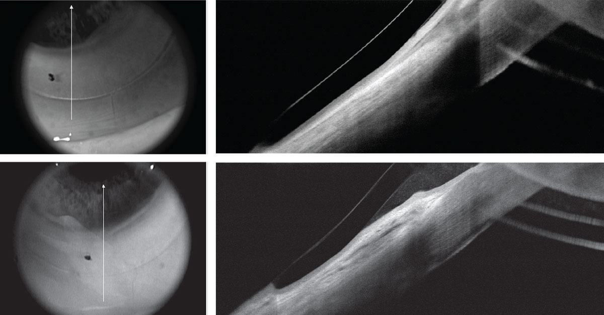 Fig 10. (Top) Post-RK/LASIK OCT with EyePrint prosthetic device in place shows impingement of the inferior conjunctiva due to conjunctival redundancy and chalasis. (Bottom) Same area following chalasis surgery without loose conjunctival entrapment.