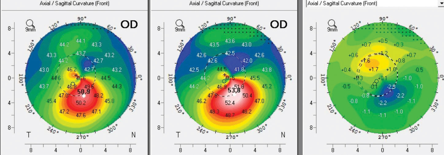 The left map was taken six months post-op, the center map was taken pre-op and the right map is the difference or subtractive map showing 2.5D of Kmax flattening. Note the superior steepening and the inferior flattening over the cone, which represents normalization of the corneal shape. This patient had a robust response to CXL.