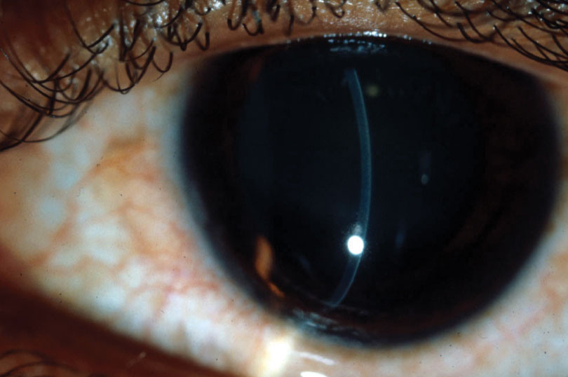 In keratoglobus, peripheral thinning of the cornea is associated with a large area of steepening.