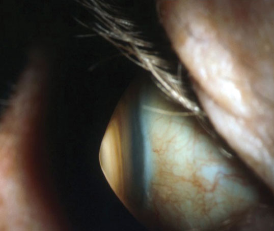 Keratoconus is associated with central corneal thinning resulting in corneal ectasia.