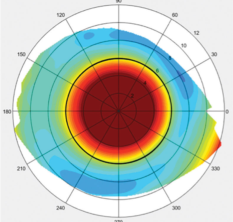 Fig. 4. This topographical scleral map was taken of an eye with a toric sclera.