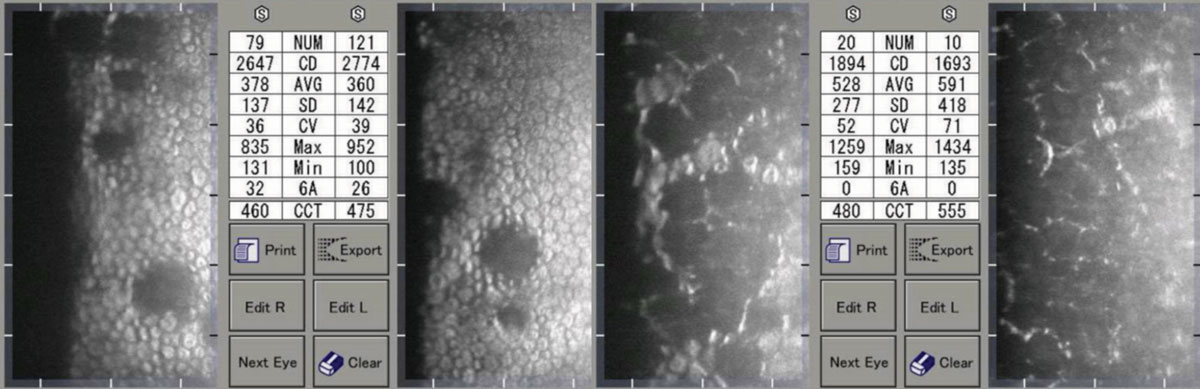 Moderate (left) and advanced (right) Fuchs’ corneal endothelial dystrophy. Note the asymmetric CCT of the patient on the right. 