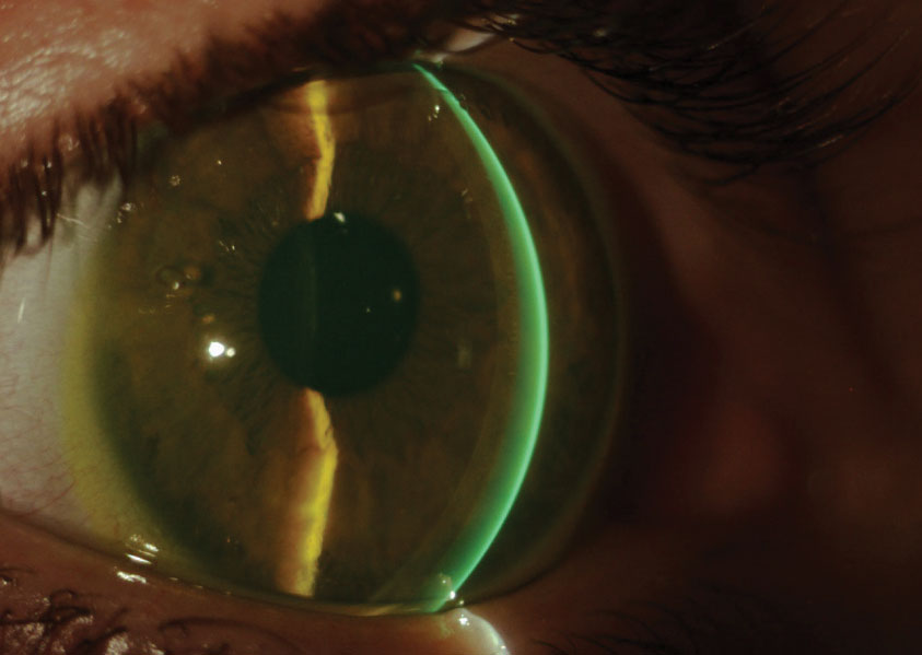 Scleral lenses can make a world of difference once a patient is educated thoroughly.