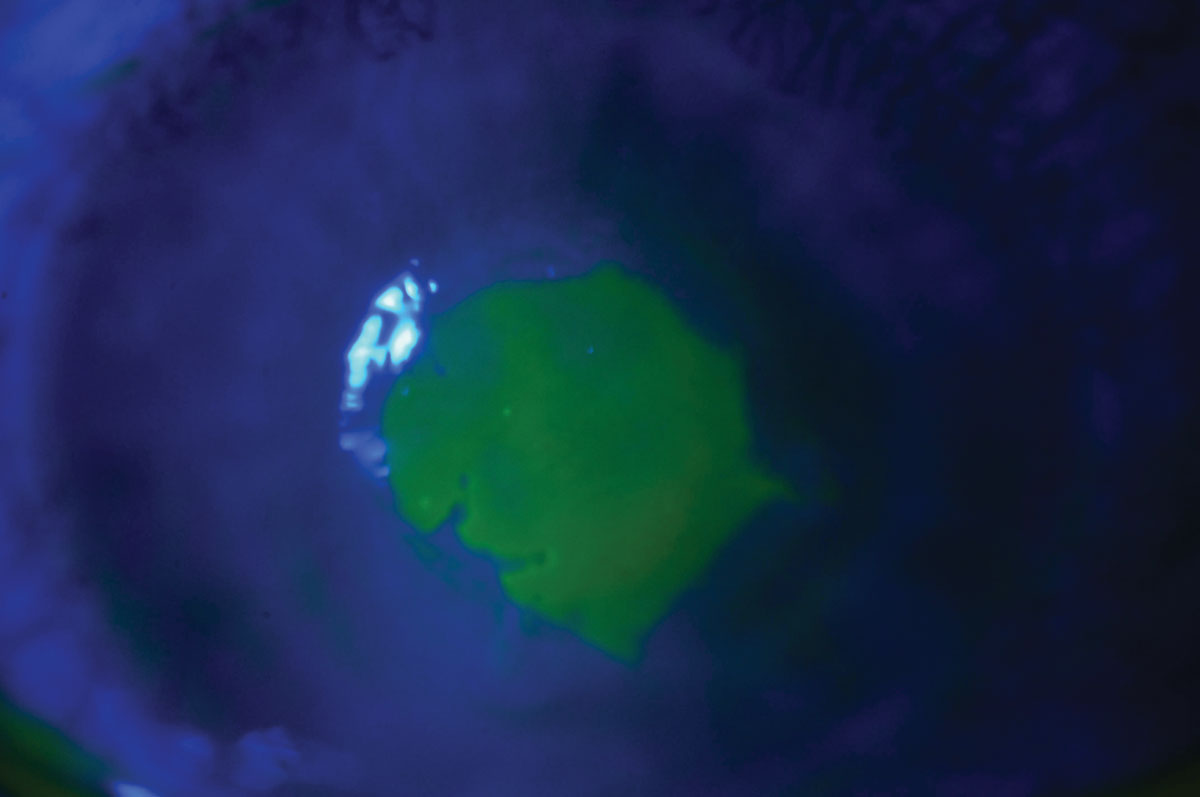 Fluorescein staining shows an active bacterial ulcer in a patient who slept in her contact lenses.
