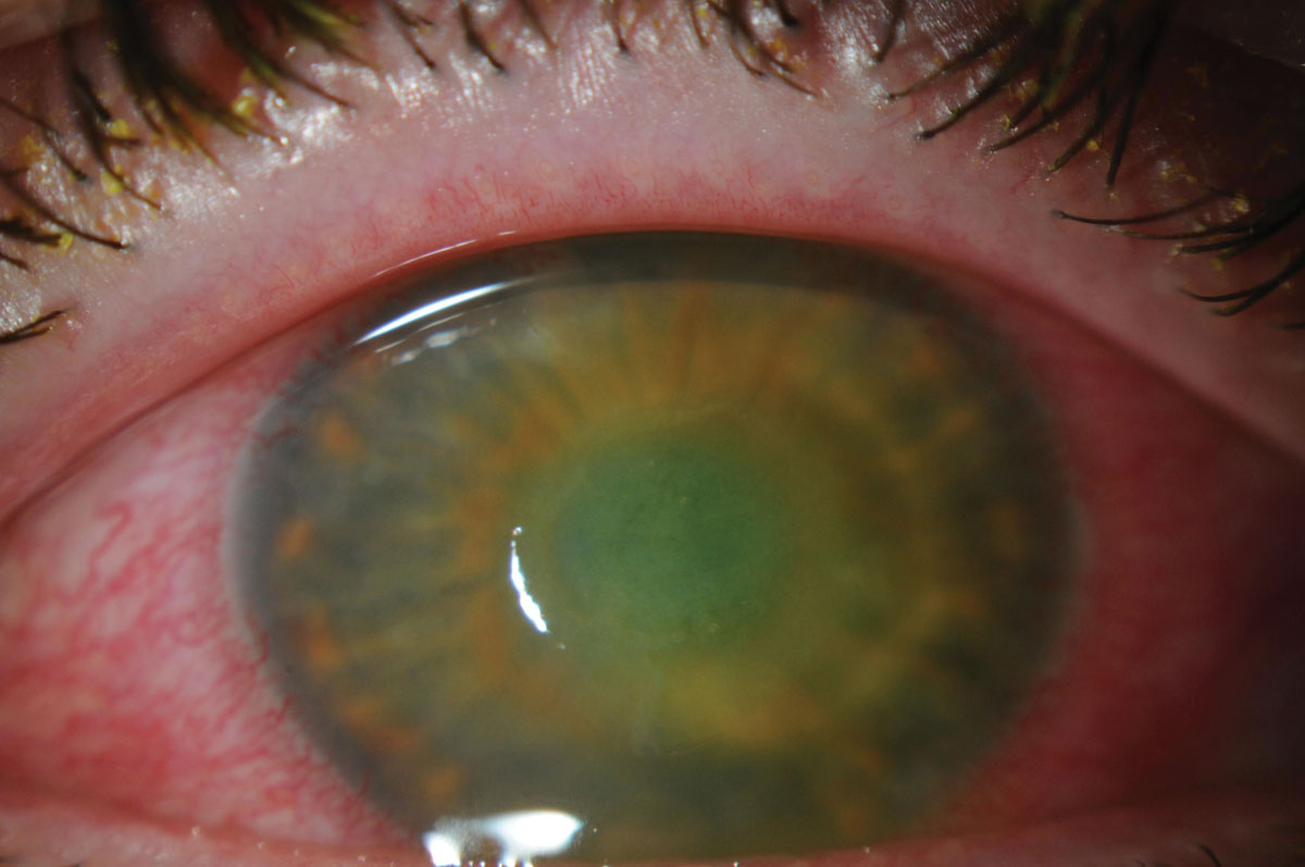 The patient’s corneal ulcer is resolving.
