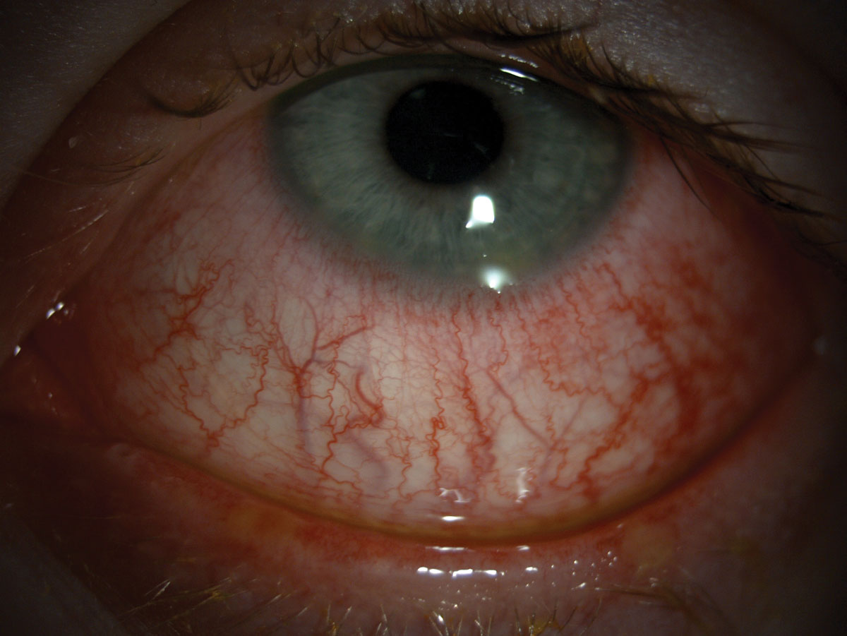 Hyperemia can be seen in this patient.