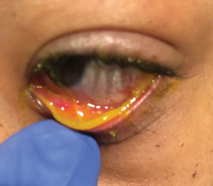 This child has subcutaneous conjunctival membranes from a bacterial infection.
