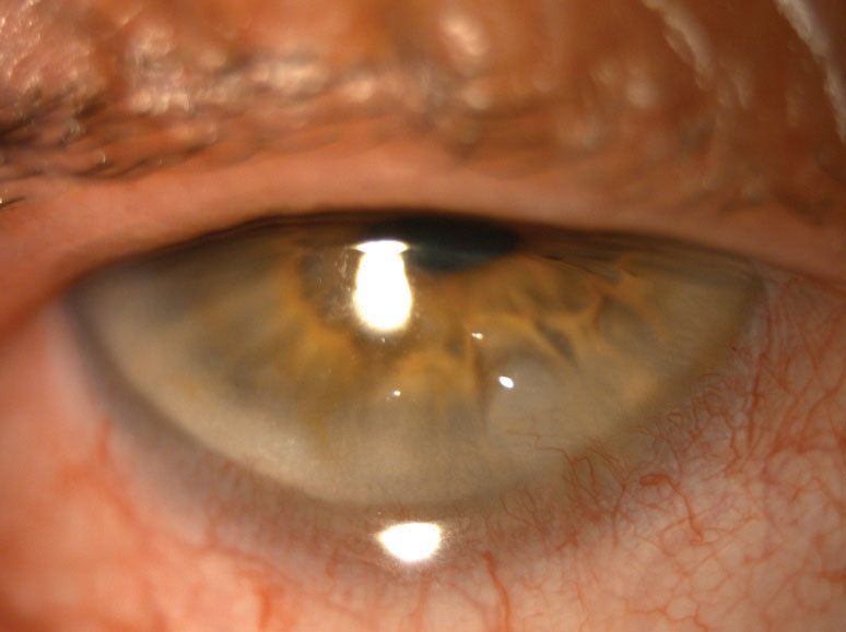 This patient's bacterial keratitis eventually resolved with antibiotics and left only with a small scar.