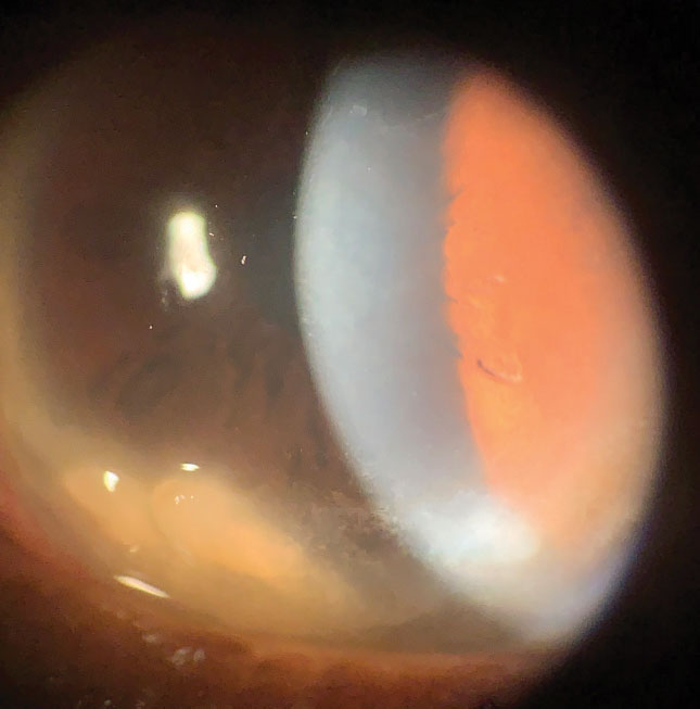 This postmenopausal female patient has chronic dry eye and bilateral Salzmann’s nodules.