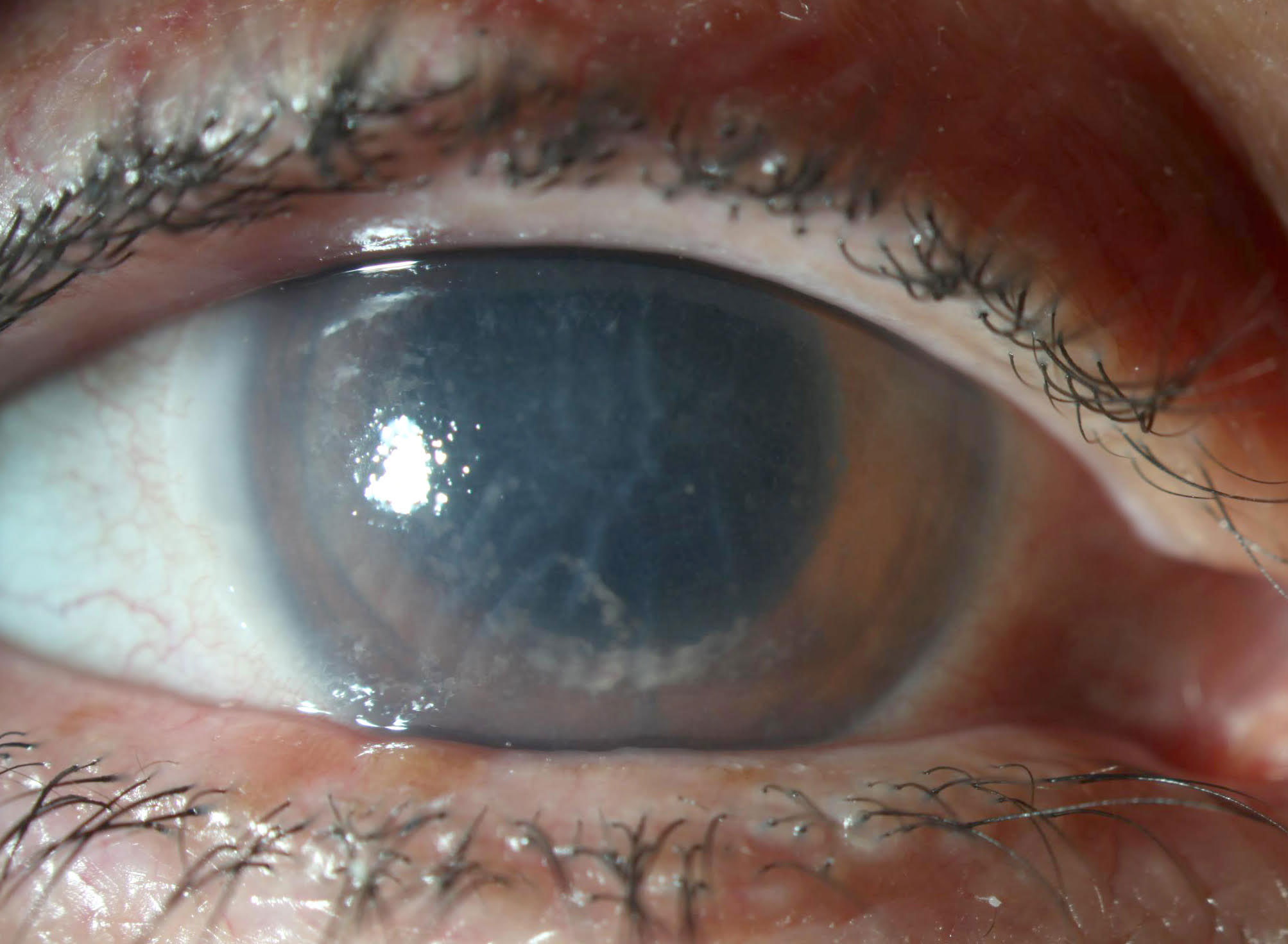 Improvement in corneal involvement after one week of aggressive therapy.
