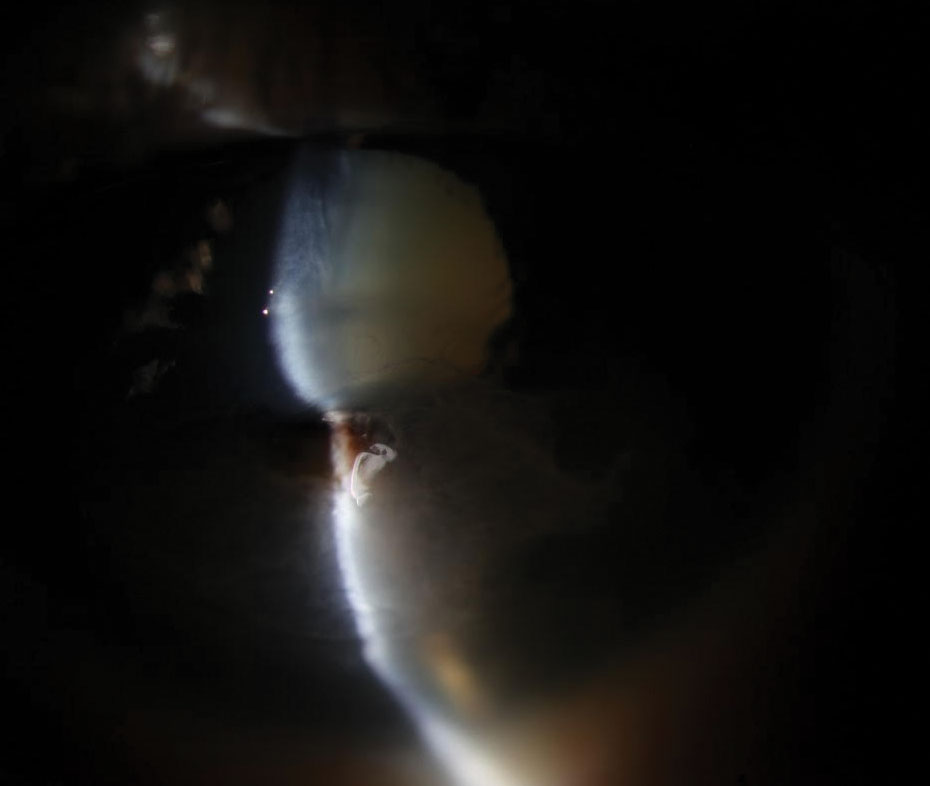 Fig. 2. Slit lamp exam revealed a perforated corneal ulcer involving the inferior visual axis with a collapsed anterior chamber and iris prolapse in the left eye.