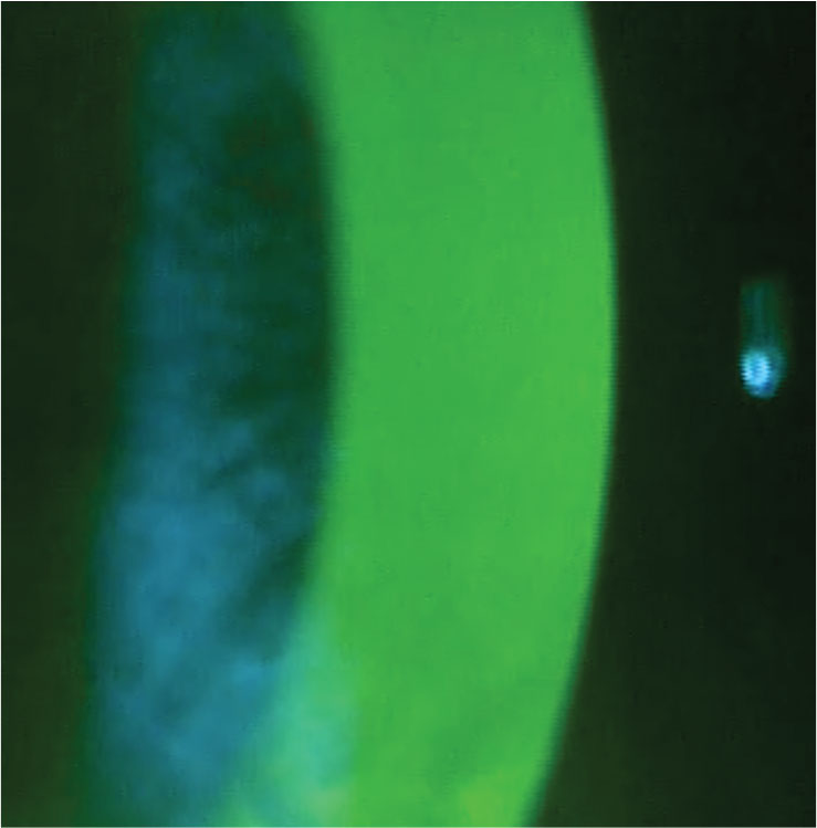 Fig. 2. Normal fluorescein pattern over the cornea.