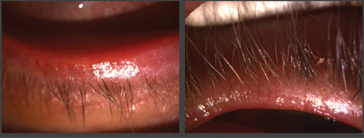 Fig. 1. The patient had significant telangiectasia and blepharitis.