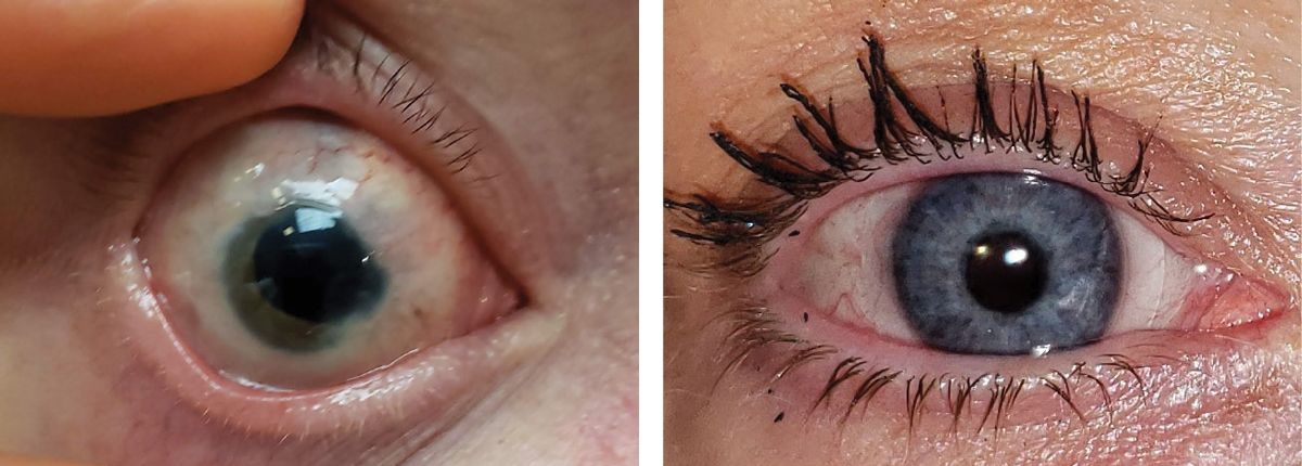 Blunt ocular injury left this eye aphakic with a ruptured iris, irregular pupil and scarred ocular surface. Placement of a prosthetic contact lens by Crystal Reflections restored the patient’s cosmetic appearance and gave her the confidence to continue her social interactions.