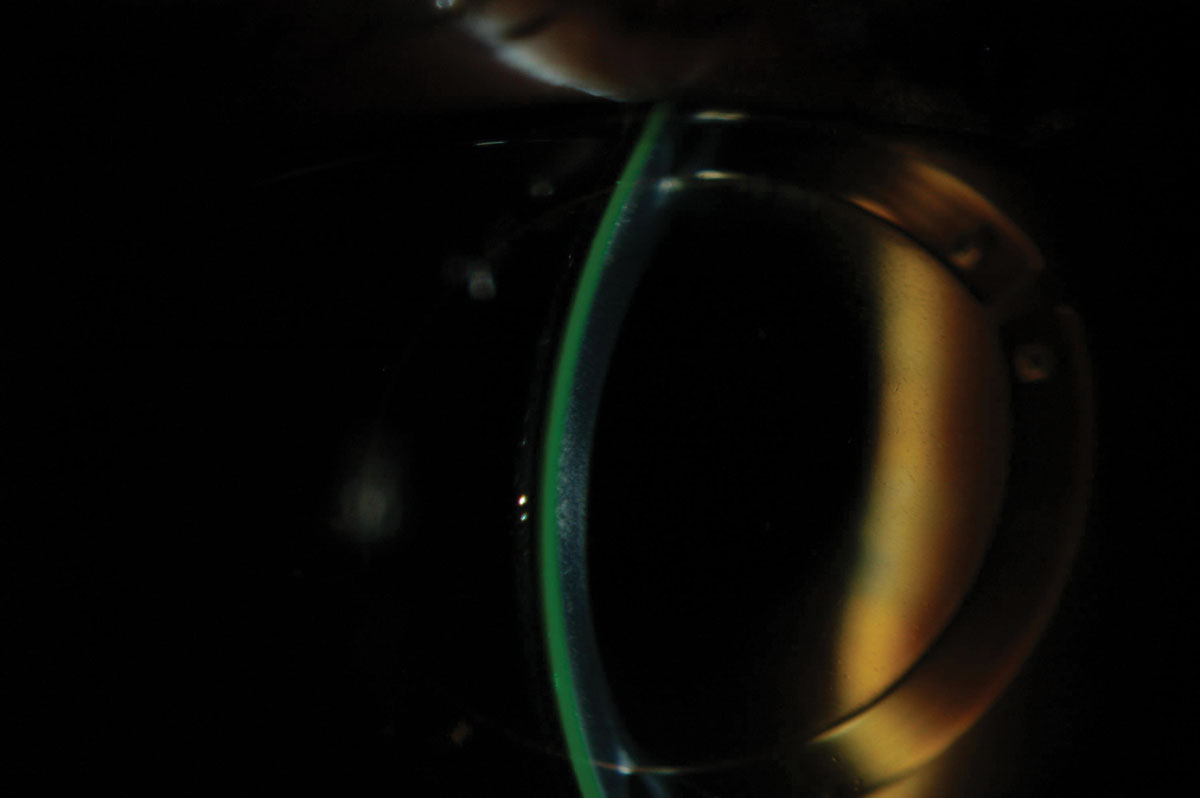 Fig. 1. Scleral lens over corneal rings.