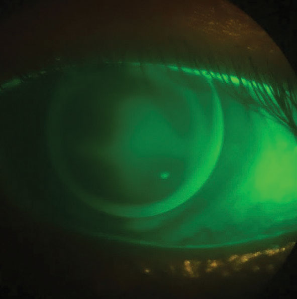 GP lens fit on a patient with corneal scarring. 