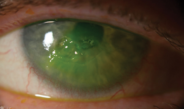 The patient’s neurotrophic corneal ulcer after fluorescein instillation.