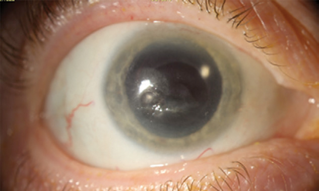 A scarred but fully healed cornea following recurrent NK.