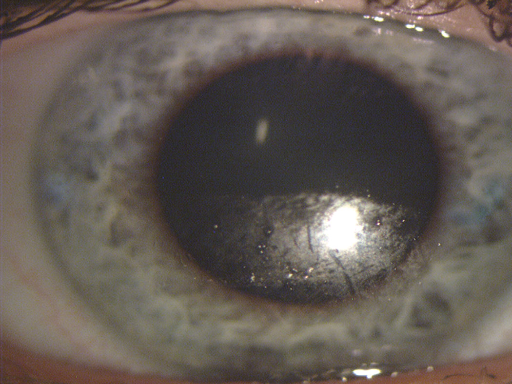 Fig. 1. This contact lens surface shows substantial drying across the inferior portion after a partial blink. Note the clear transition from dark (replenished) superior to speckled (dried) inferior portion of the lens, identifying where the downward movement of the blink ended. 