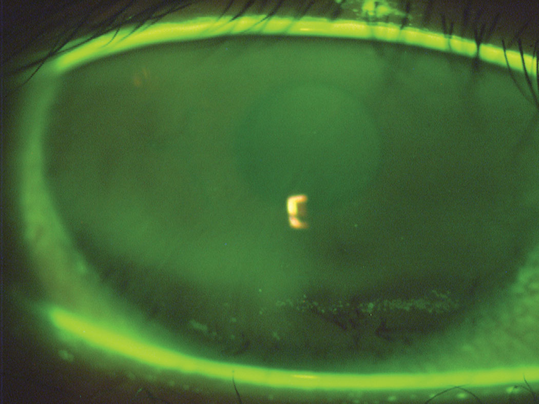 Fig. 2. This image depicts inferior dehydration staining due to incomplete blinking. The darker horizontal band in the stained area corresponds to the turning point of the lid between the downward and upward motion of the blink.