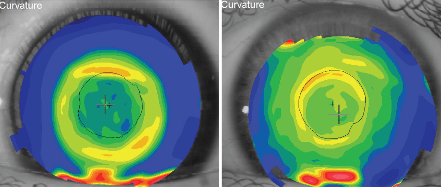 Topography of a successful orthokeratology patient’s cornea (left). Topography over the surface of a distance-centered multifocal contact lens (right).