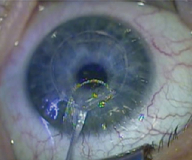 Fig. 2. A donor lenticule harvested from a SMILE refractive patient is ready for trephining into a 1.0mm-diameter intrastromal implant.