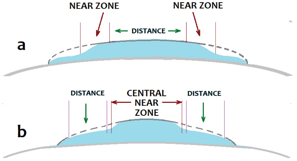 Fig. 4. There are two configurations of PresbyLASIK: a near peripheral corneal annular zone with a distance central zone (a) and a near central corneal zone with a peripheral annular distance zone (b).