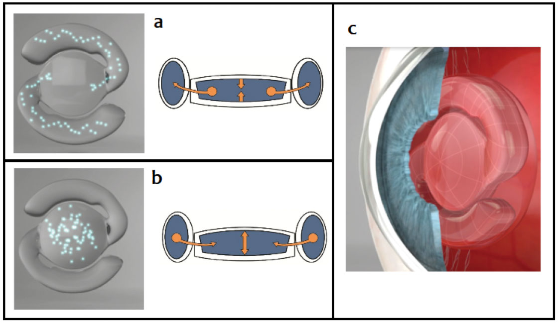 Fig. 5. In the un-accommodated state (a), a minute amount of fluid streams from the central optic into the peripheral balloon haptics of the lens, and the distance power of the optic is obtained. Upon accommodation and radial contraction of the lens capsule by the ciliary body (b), the fluid streams into the central optic, increasing its plus power for near vision provided by the FluidVision AIOL (c).