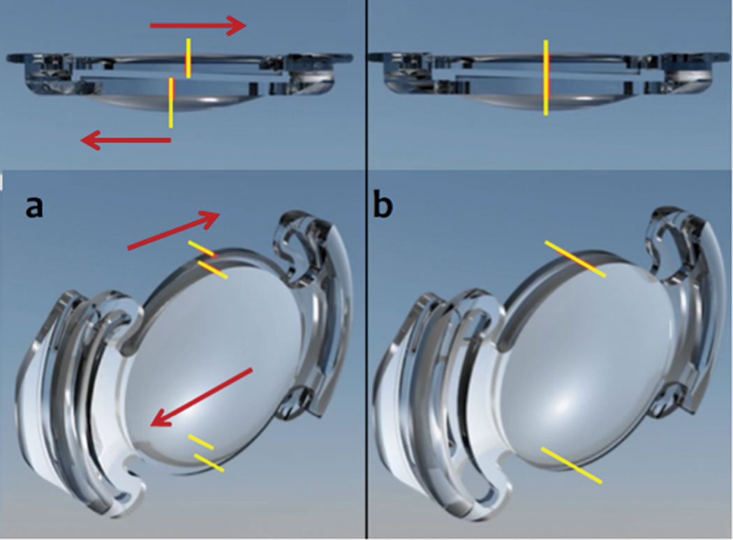 Fig. 6. As the ciliary body of the Lumina AIOL compresses the lens haptics (a), the lenses translate in apposition to each other, increasing plus power. With relaxation of the ciliary body (b), the lenses line up with the appropriate distance power.