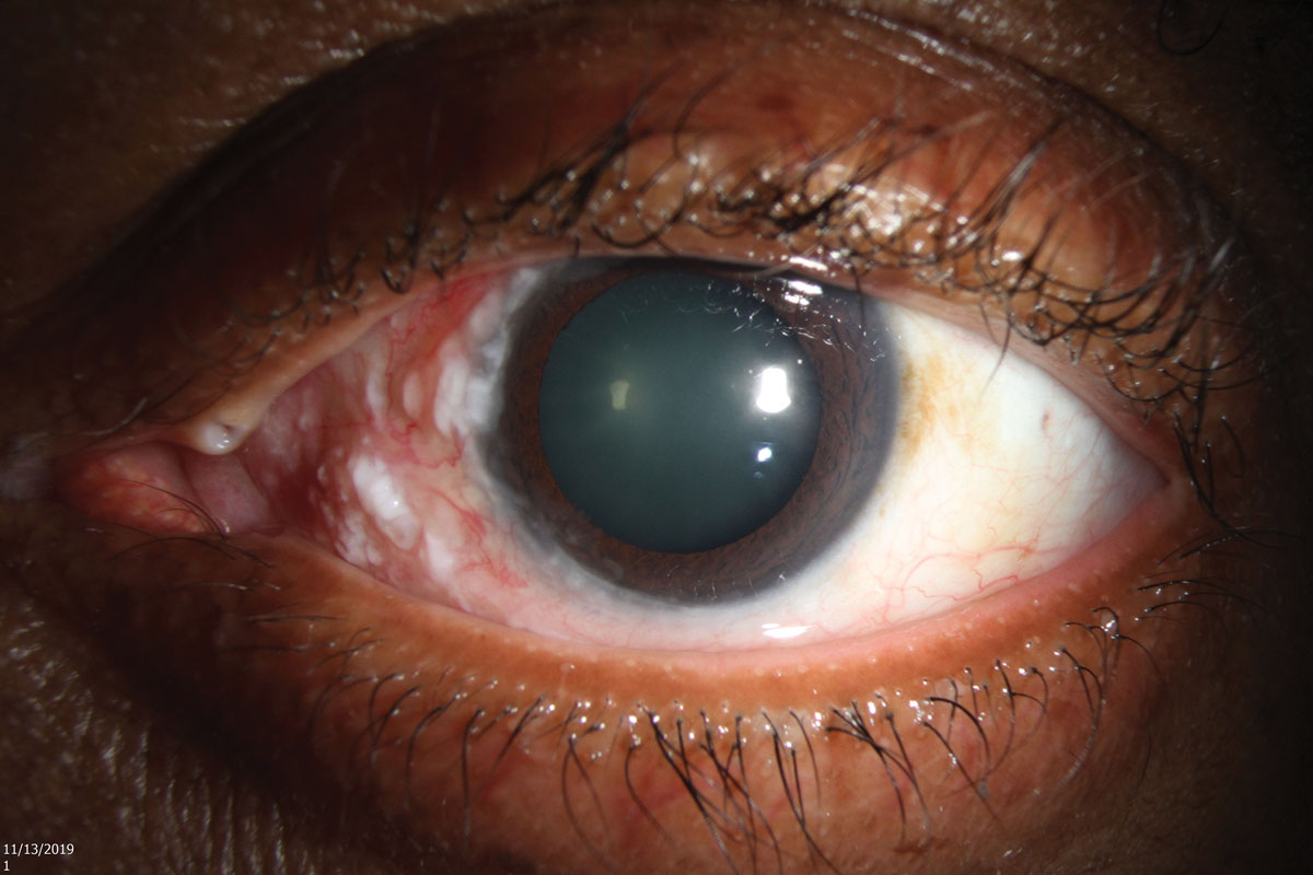 Fig. 1. Slit lamp photo of the ocular surface lesion involving the nasal conjunctiva and limbus.