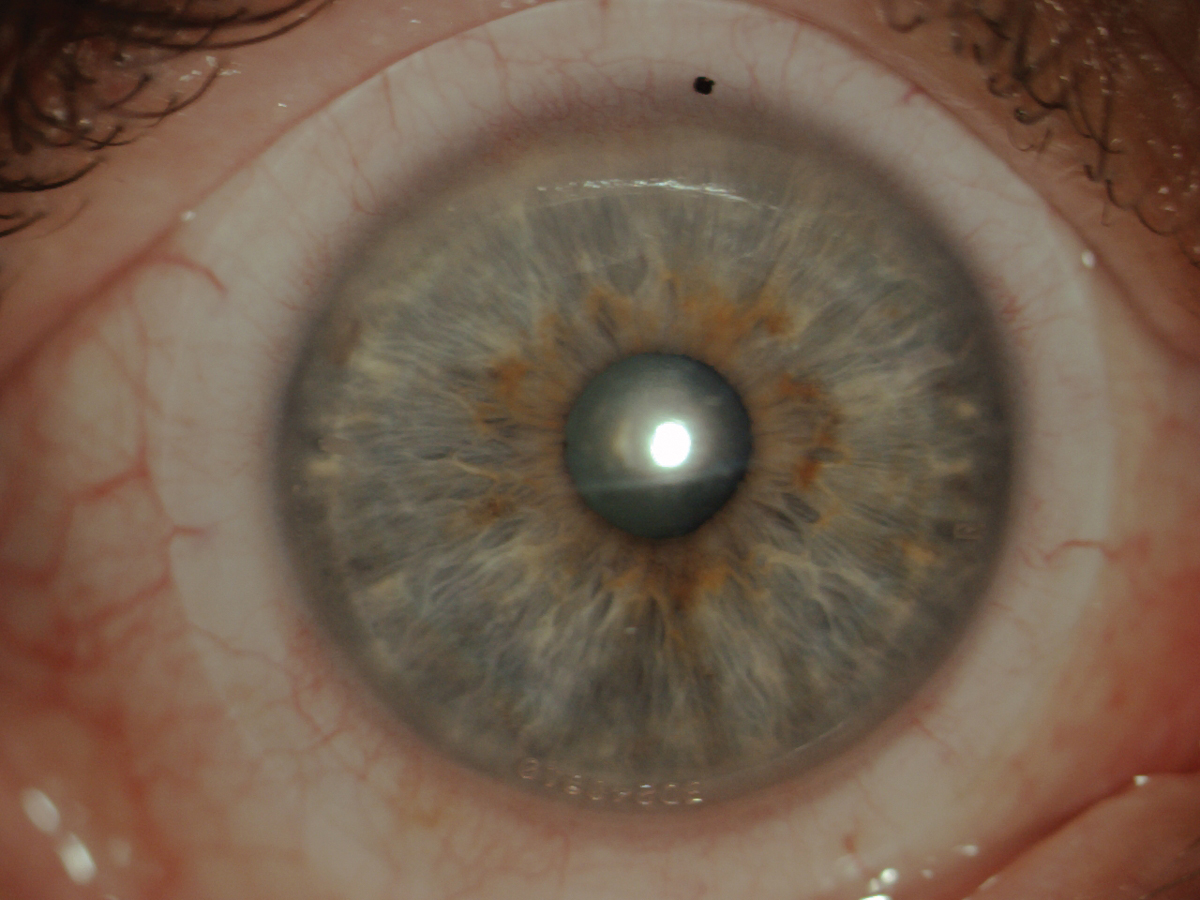 This multifocal scleral was ordered after the single vision lens was fit successfully and best distance acuity achieved. 