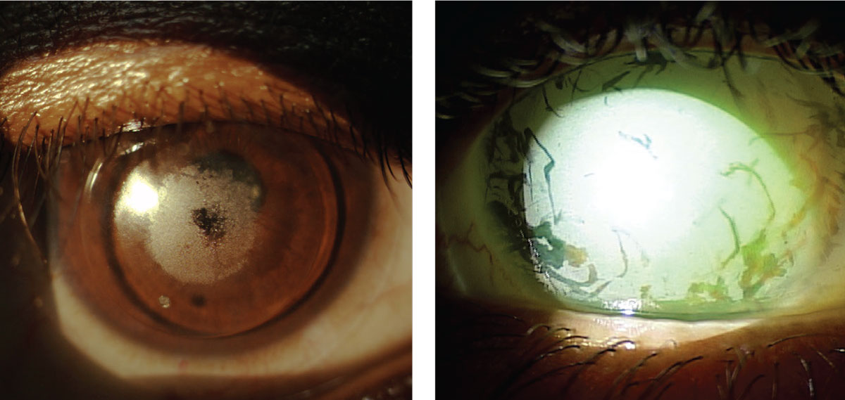 Fig. 2 and 3. Piggyback system with large central area of non-wetting on the GP lens (left). Extensive front surface non-wetting on a 16.0mm scleral lens (right). 