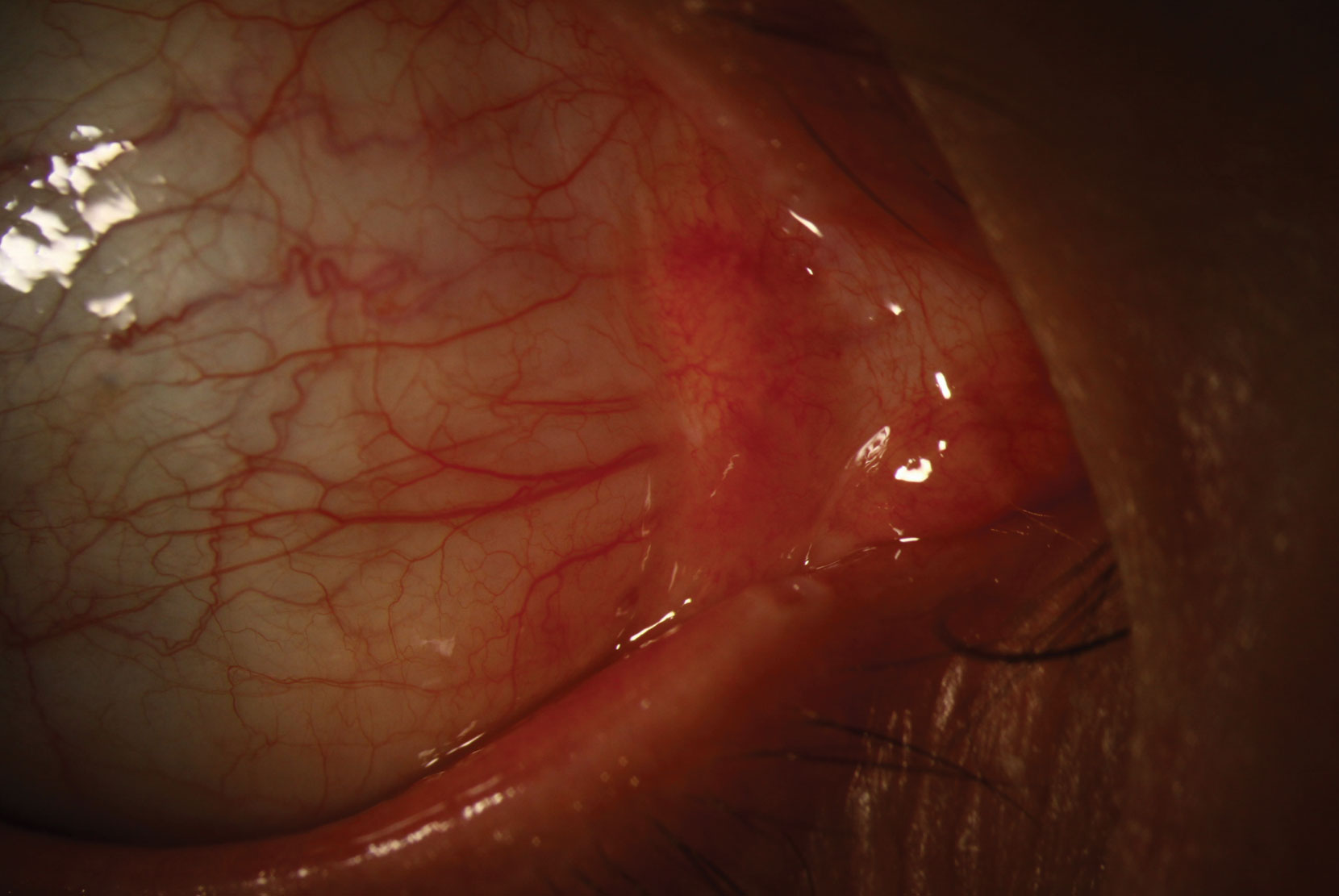 Scleritis is an inflammatory process that involves dilation of the superficial and deep episcleral vessels.