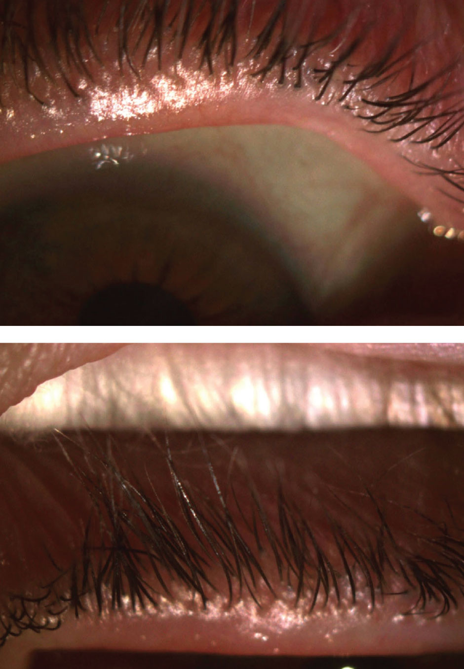 After discontinuing contact lens wear for a week, the patient’s lashes were still pouted (OD on the top).