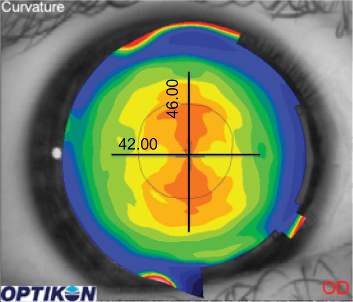 Centrally located astigmatism can often be fit with a spherical GP lens.