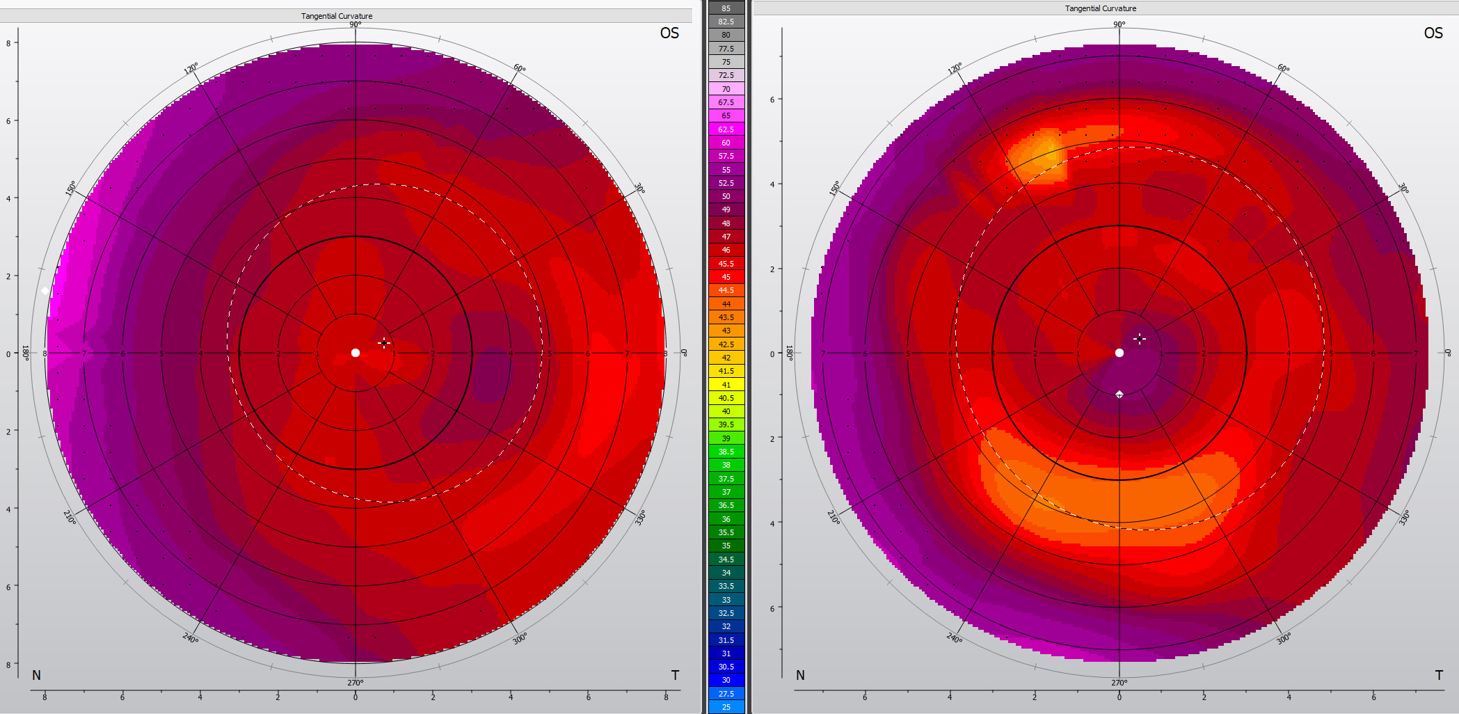 This presbyopic dry eye patient placed their scleral multifocal lens with a decentered add on the eye upside down (left). After rotating the lens 180 degrees, the reading add was positioned correctly (right).