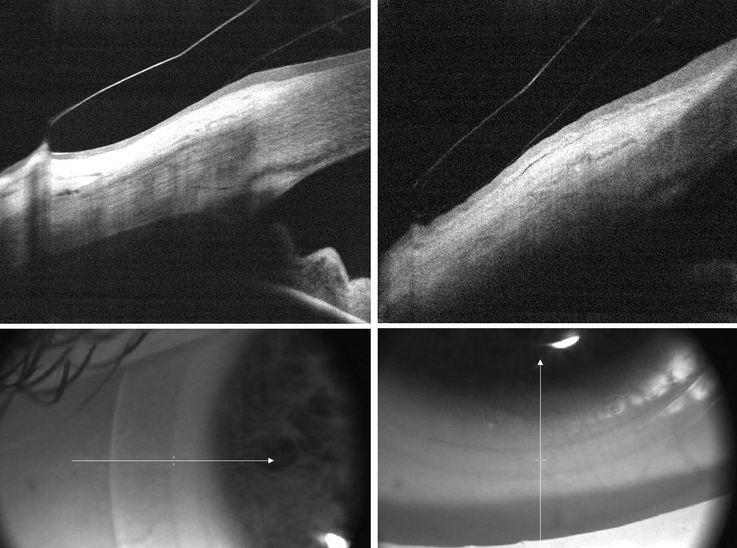 To correct edge lift in the vertical meridian in this trial fit spherical scleral lens, we ordered toric peripheral curves flatter along the horizontal and steeper along the vertical meridians.