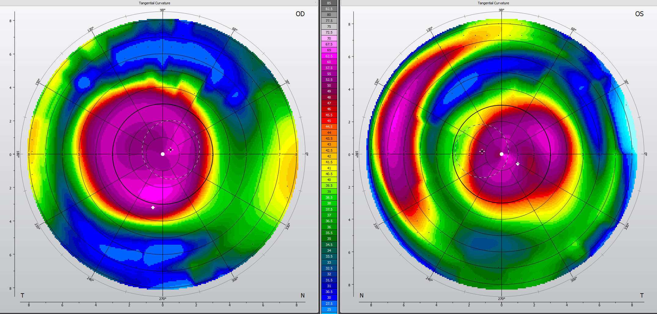 Corneal topography of advanced keratoconus OU successfully fit with Kerasoft IC Toric lenses.