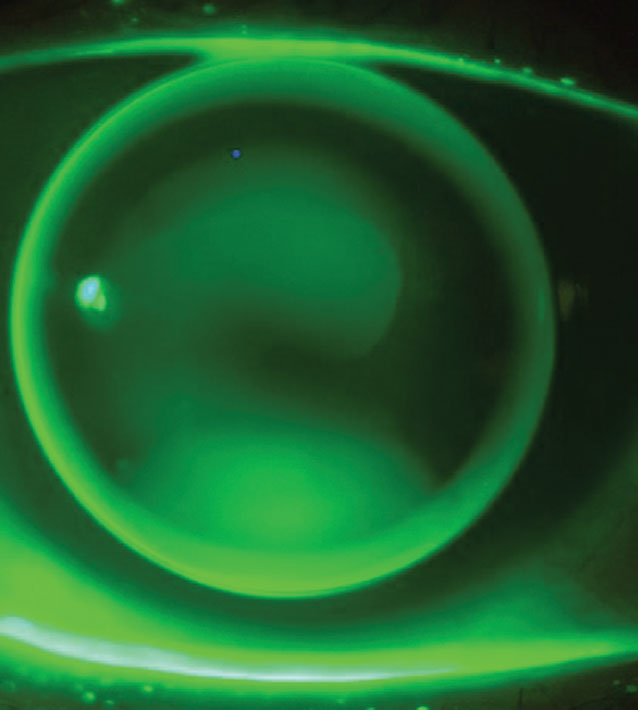 Fig. 1. The “three-point touch” pattern of a small (9.2mm) OAD lens for a patient with keratoconus.