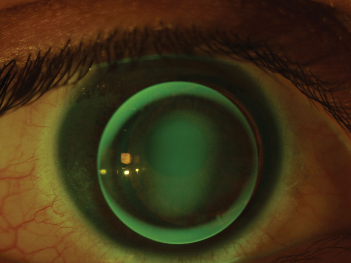 Fig. 1. Temporal corneal staining present at follow-up on a keratoconic corneal GP lens. 