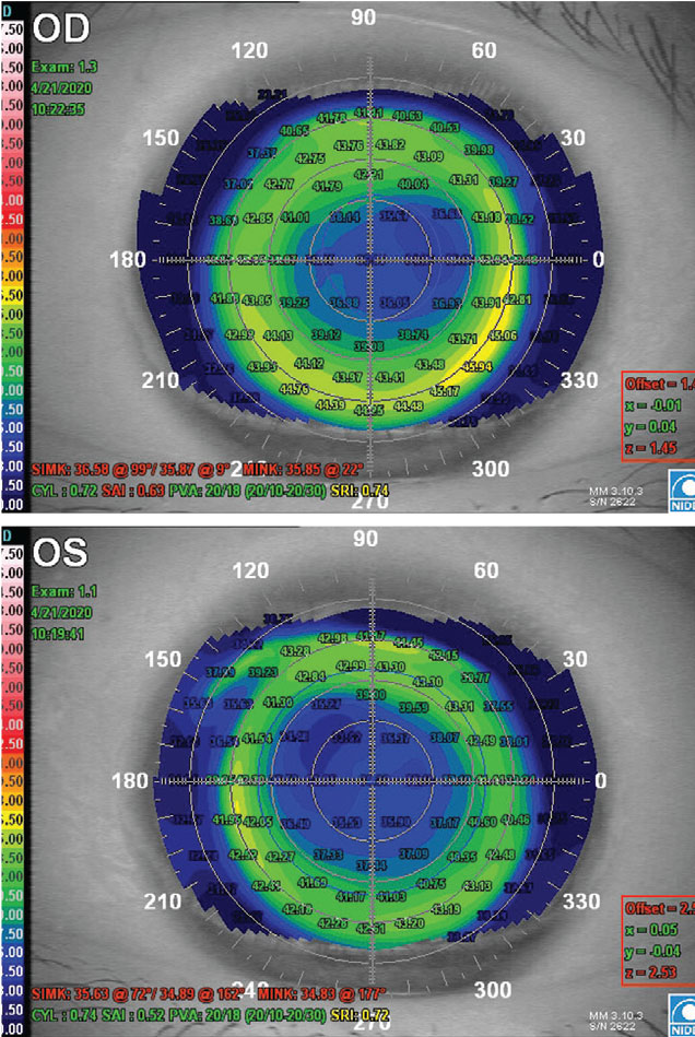 Fig. 1. Post-LASIK placido disc topography of a highly myopic patient with a deeply central oblate pattern without ectasia, central islands or irregular astigmatism.